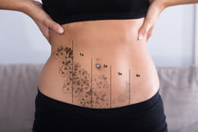 Cargar imagen en el visor de la galería, Remoción tatuajes