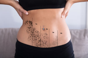 Remoción tatuajes